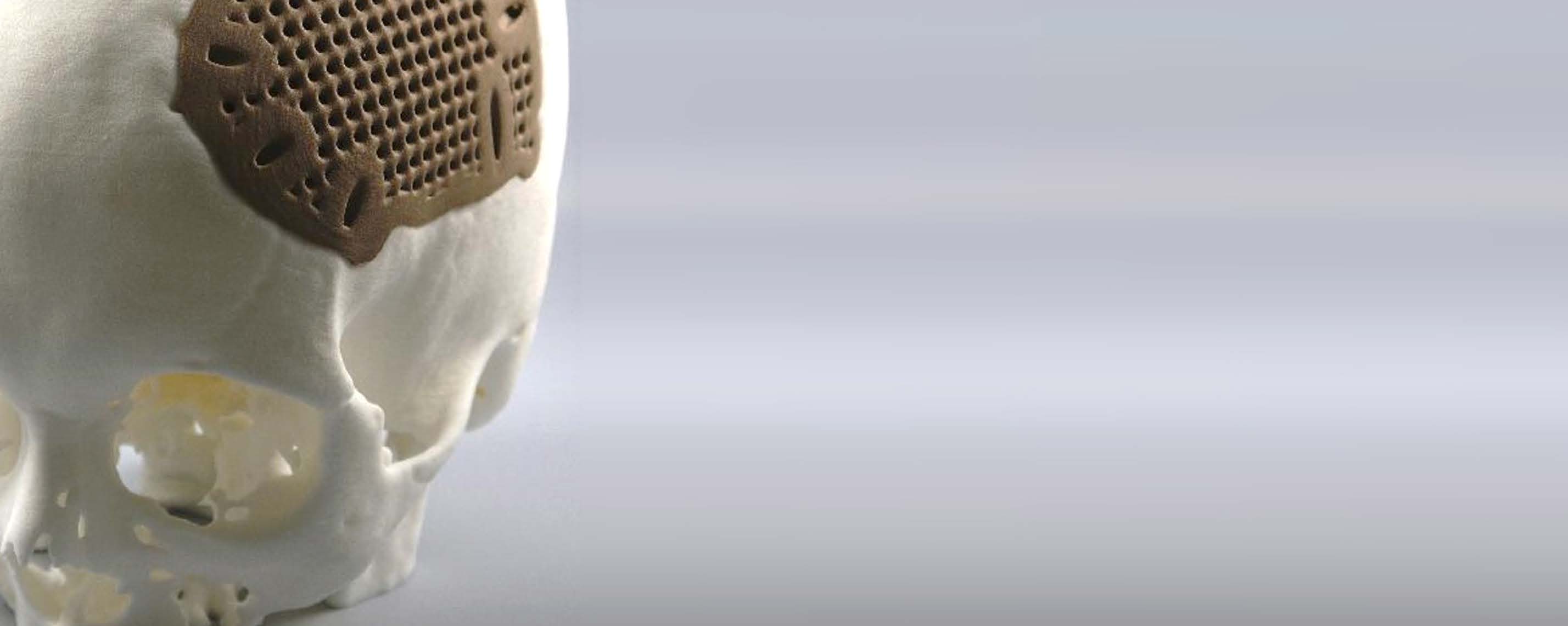 Implante craniofacial impresso em PEEK